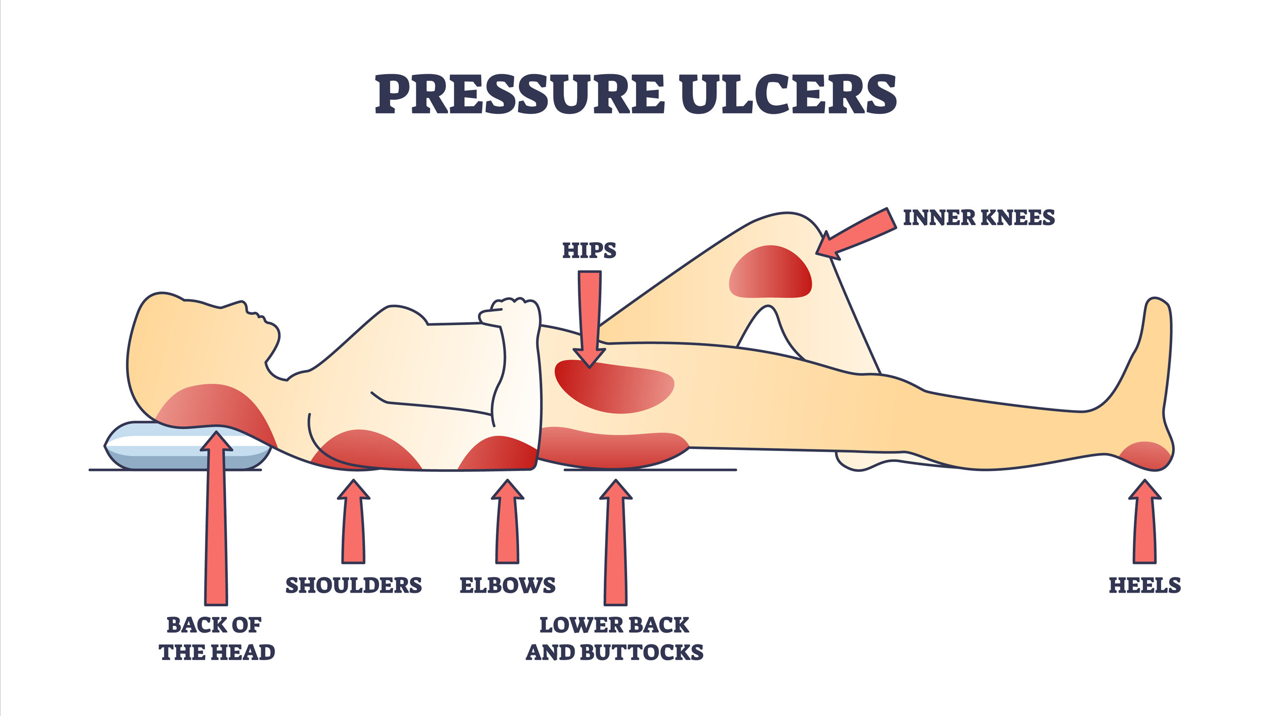 Pressure Ulcers and pressure injury